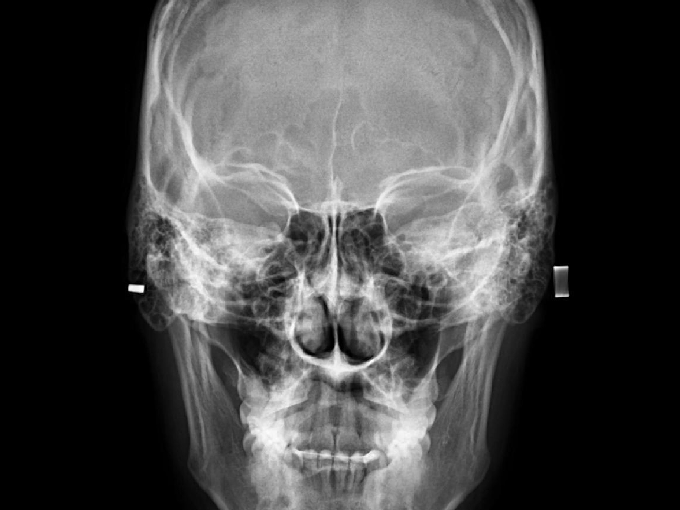 Cefalométrica Frontal